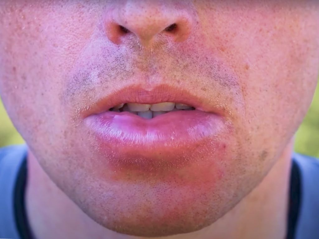 Sonhar com Boca Inchada