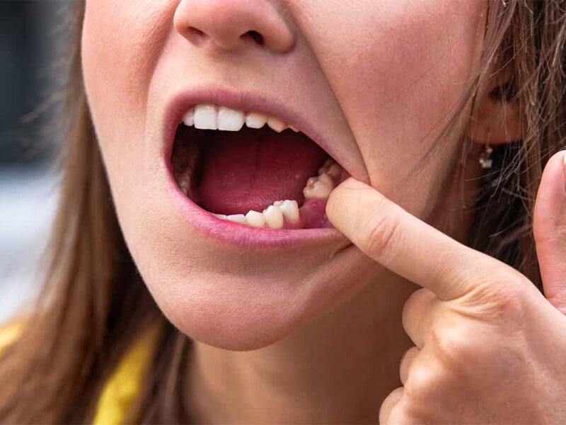 Sonhar com Dentes Caindo