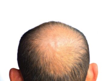 Sonhar com Careca