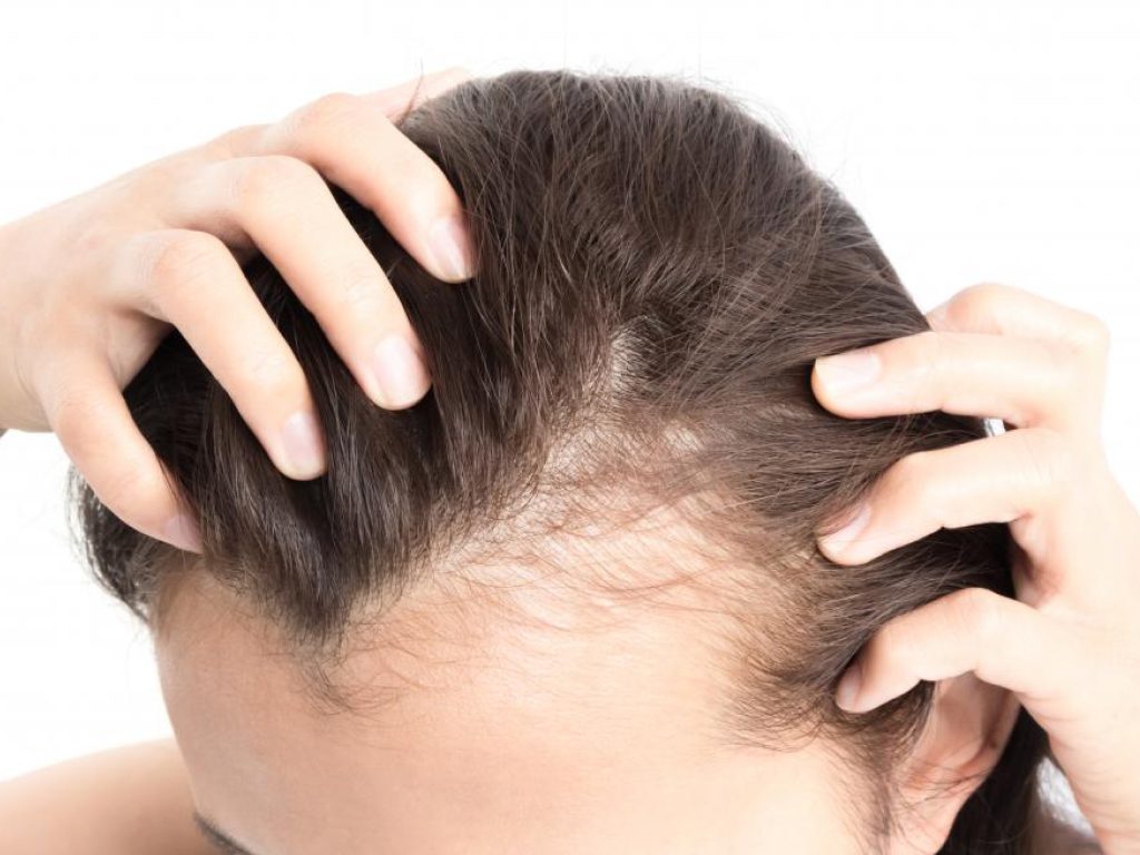 Sonhar com Calvície Parcial Feminina