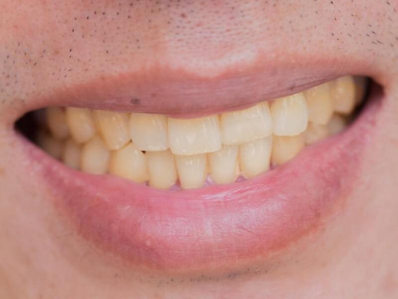 Sonhar com Dentes Amarelos