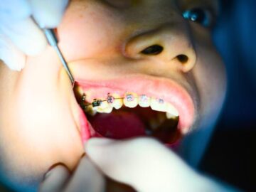 Thumbnail Sonhar com Dentes Fixos