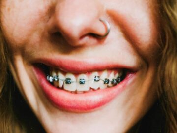 Thumbnail Sonhar com Dentes com Aparelho Ortodôntico
