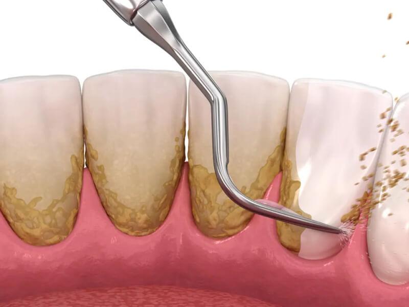 Sonhar com Dentes com Tártaro