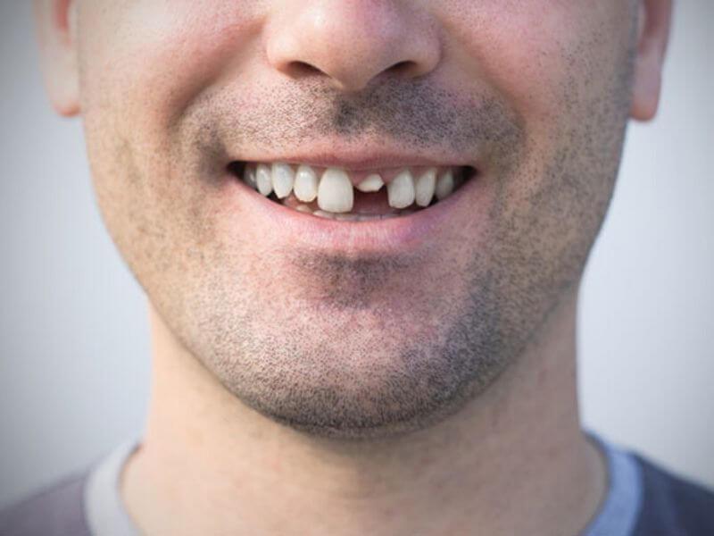 Sonhar com Dentes Sem Caroço