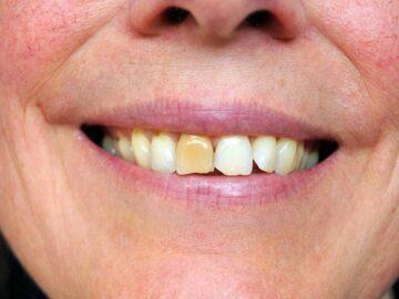 Sonhar com Dentes Sujos