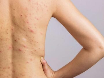 Sonhar com Espinhas no Corpo