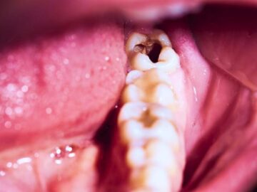 Sonhar com Dente Danificado