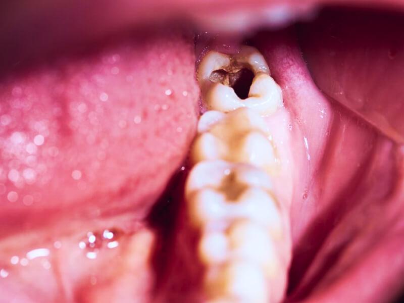 Sonhar com Dente Danificado