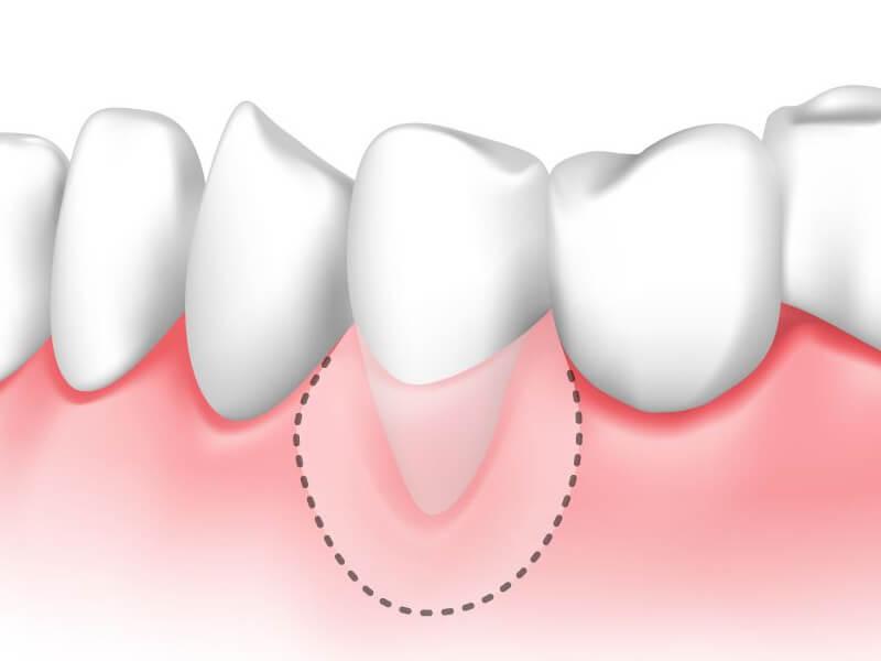 Sonhar com Dentes Descobertos
