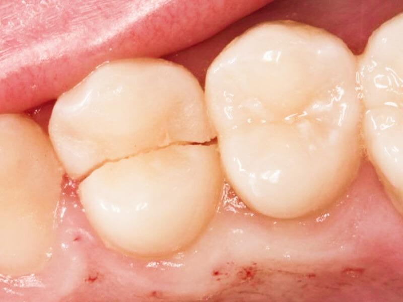 Sonhar com Dente Rachado