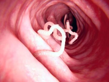 Thumbnail Sonhar com Parasitas Intestinais