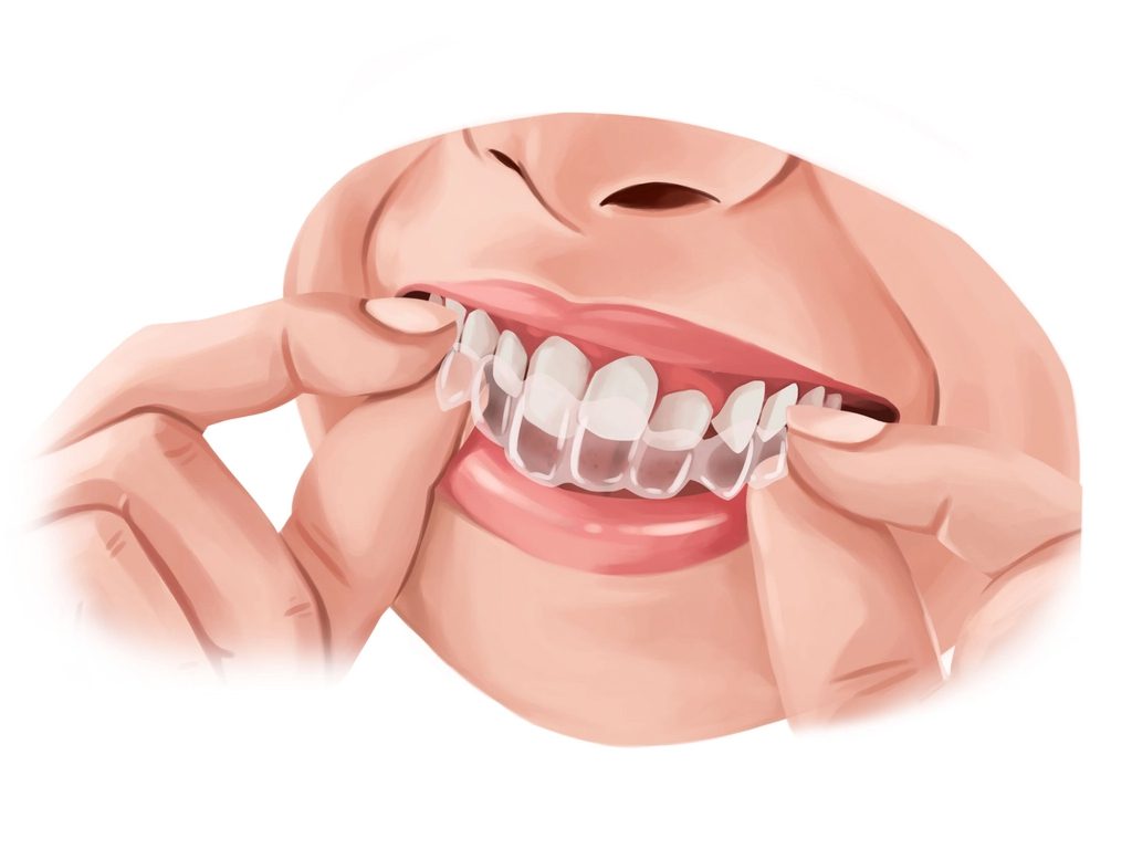 Sonhar com Plástico nos Dentes