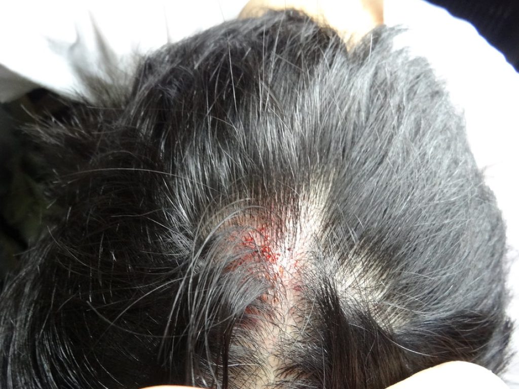 Sonhar com Sangue na Cabeça