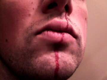 Thumbnail Sonhar com Sangue no Nariz