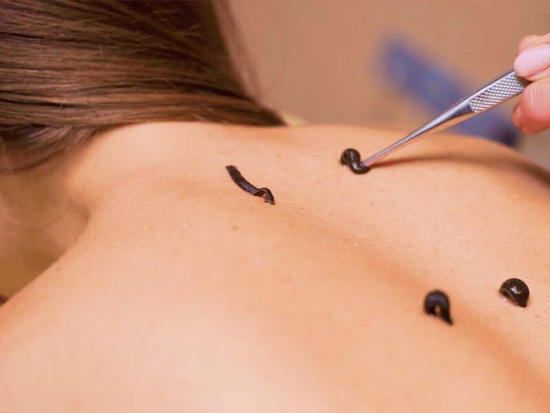 Sonhar com Sanguessugas no Corpo