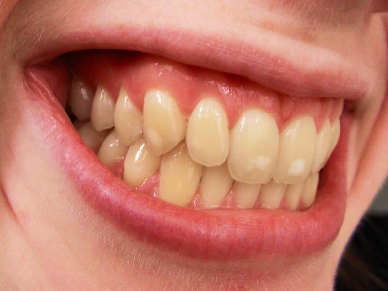 Sonhar com Sujeira nos Dentes