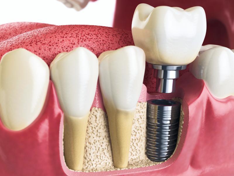 Sonhar com Parafusos nos Dentes