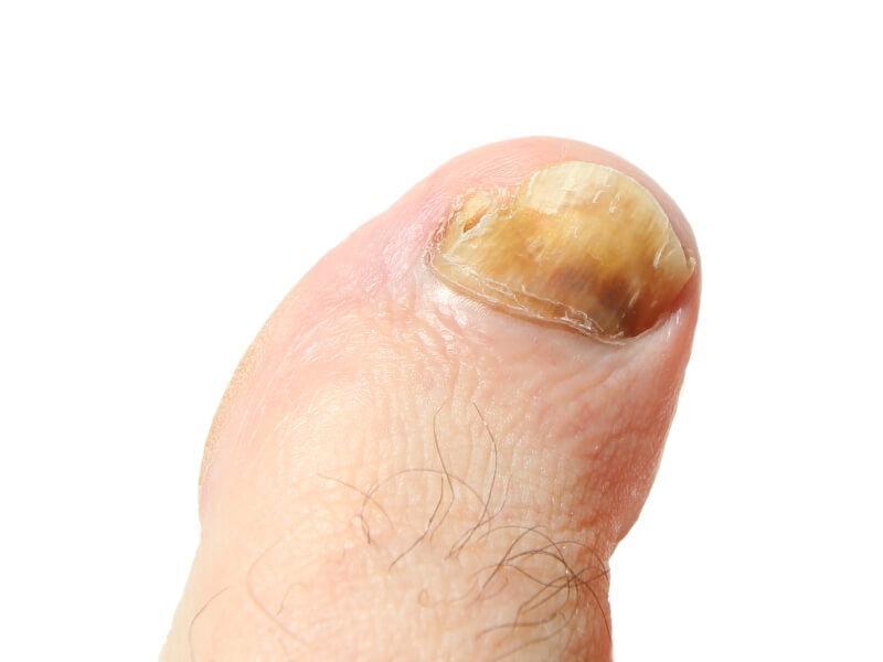 Sonhar com Unhas com Fungos
