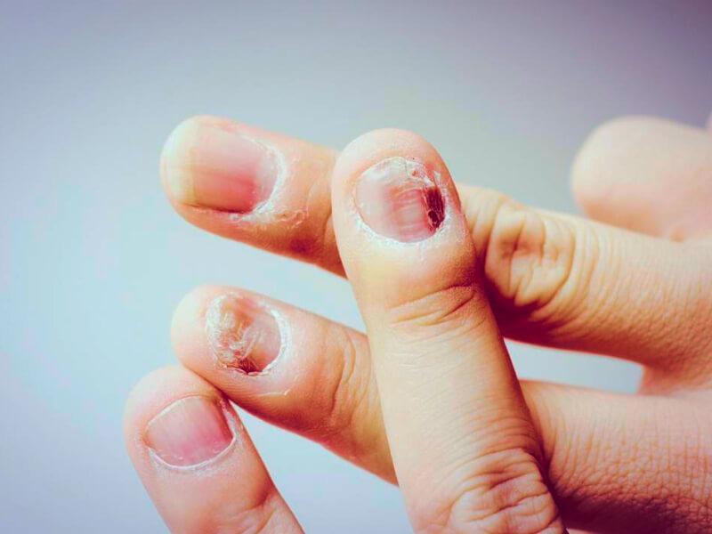 Sonhar com Unhas podres