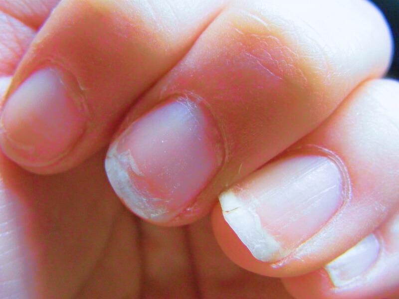 Sonhar com Unhas Quebradas